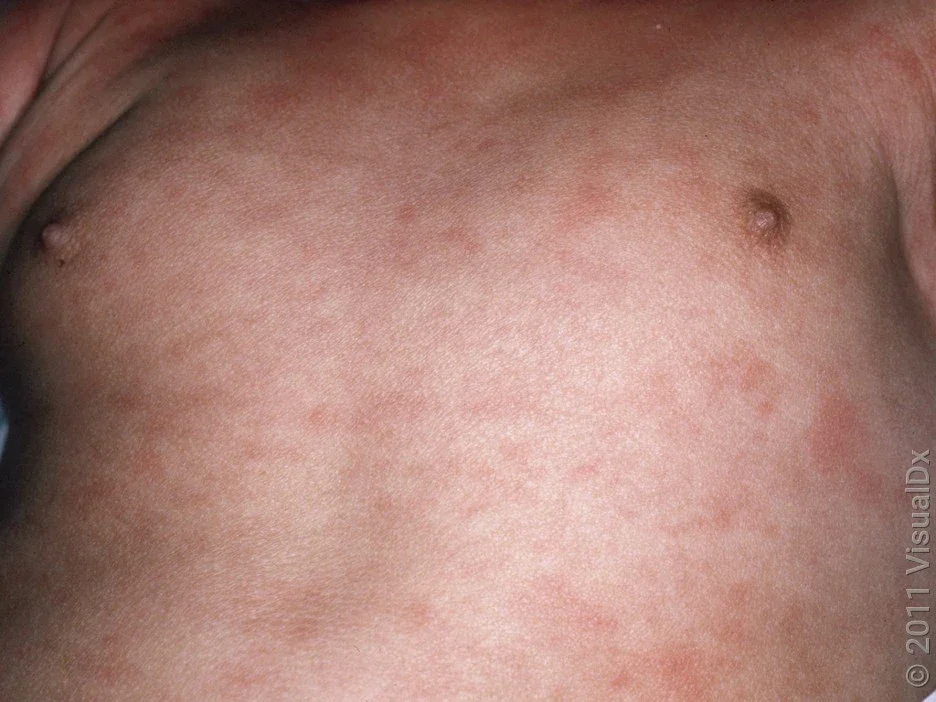 A torso with an antibiotic rash. 