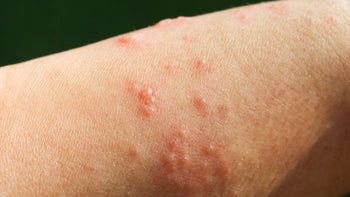 Health: Covid 19: close up shingles-1176815795