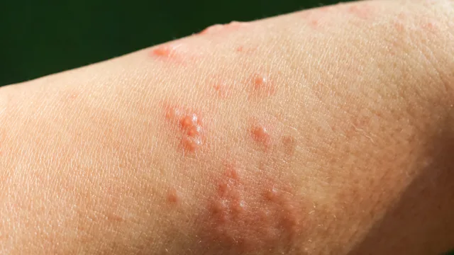 Health: Covid 19: close up shingles-1176815795
