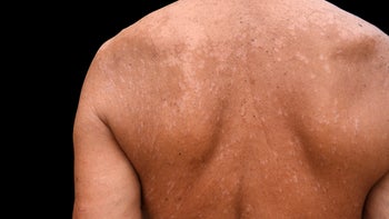 Health: Tinea versicolor: shutterstock 699807043