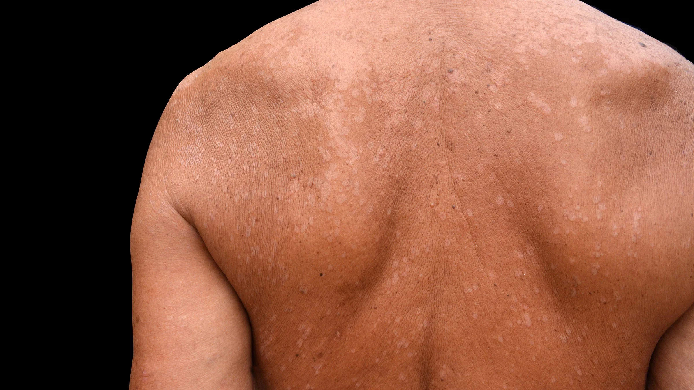 Cropped shot of a person's back with tinea versicolor.
shutting via Shutterstock