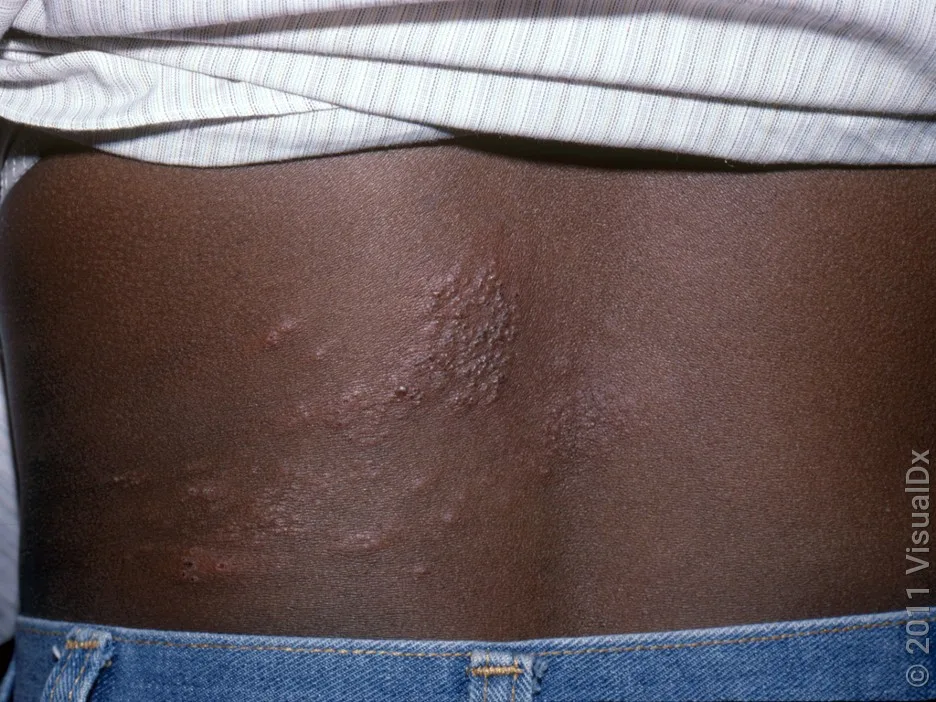 Shingles rash on the back.
