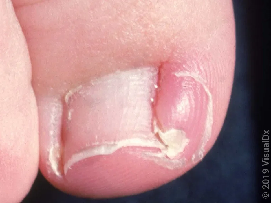 Close-up of an infected ingrown toenail. 