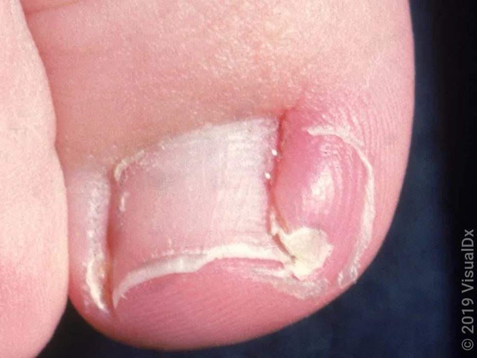 Close-up of an infected ingrown toenail.
