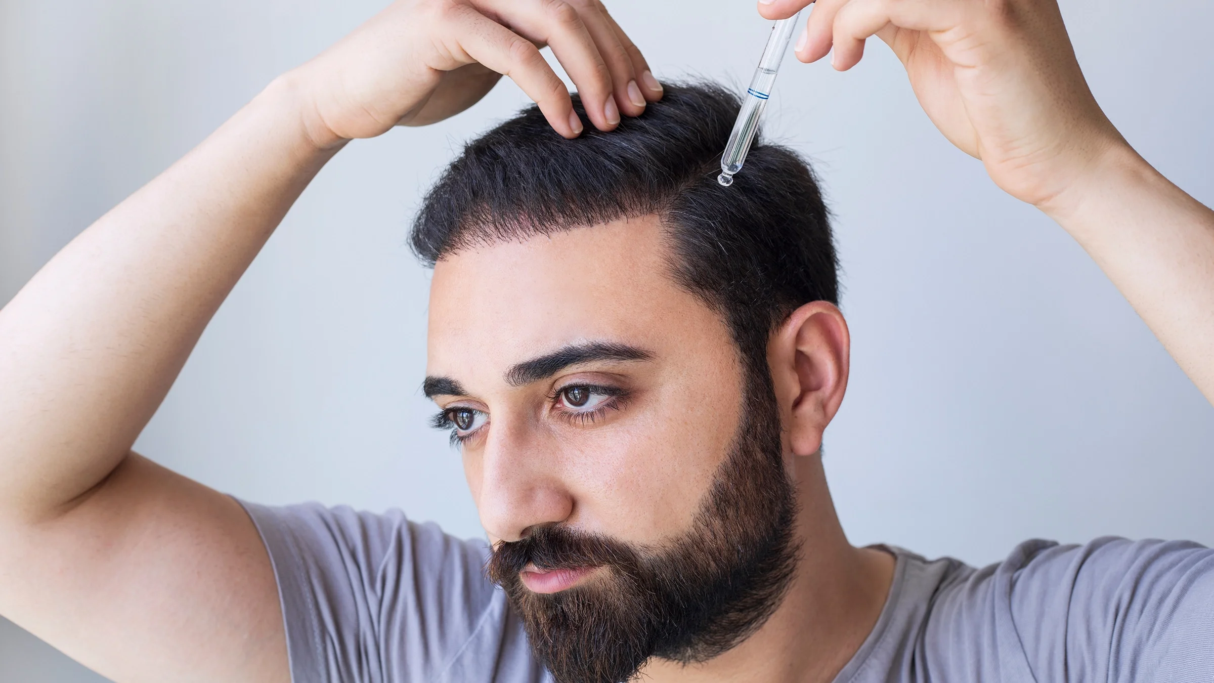 A man applies a liquid solution to his scalp for hair loss.