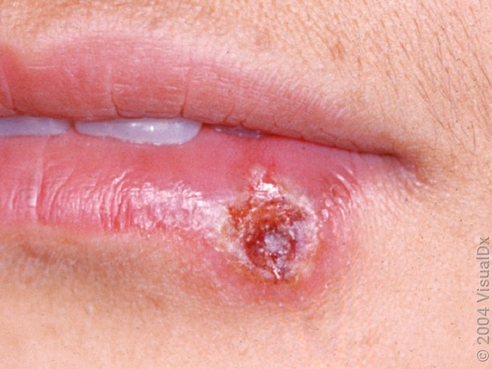 Close-up of a lip cold sore starting to crust over. 