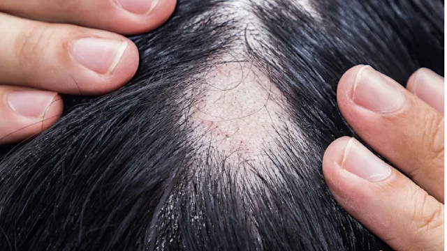 Health: propecia: closeup patch of hair loss-1264331253