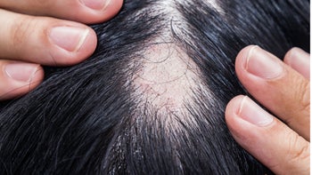 Health: propecia: closeup patch of hair loss-1264331253