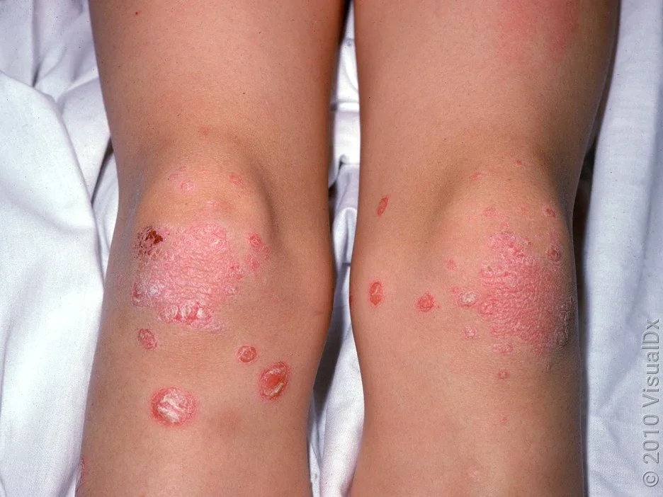 Close-up of psoriasis on and around the knees. 