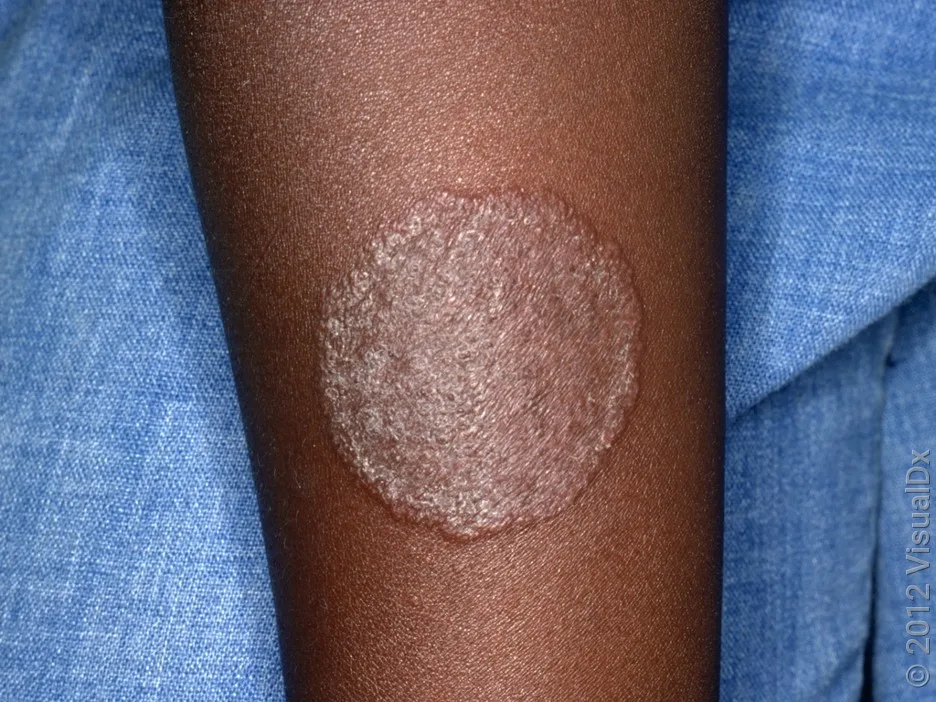 Close-up of ringworm on the arm.