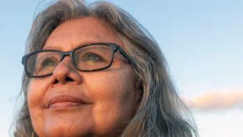 Dermatology: portrait of woman with liver spots 1440076403