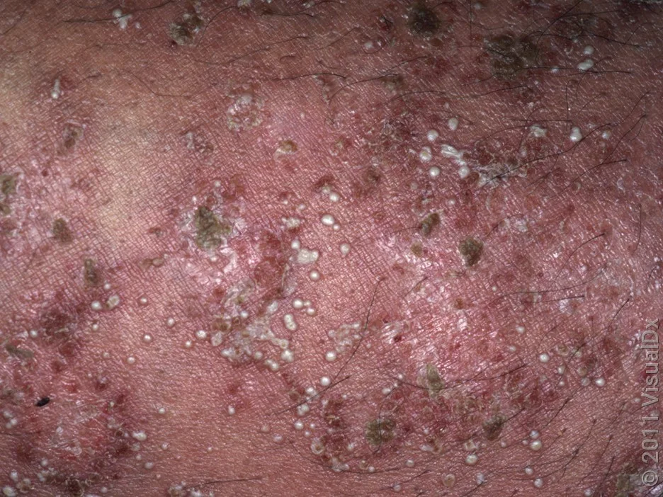 Close-up of pustular psoriasis. 