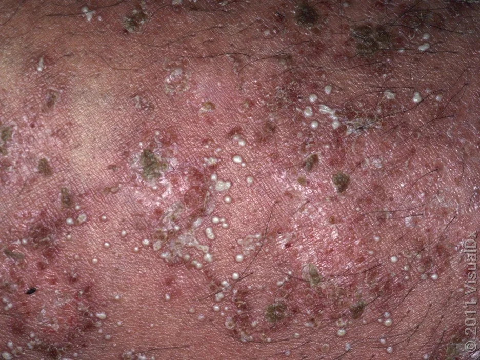 Close-up of pustular psoriasis. 