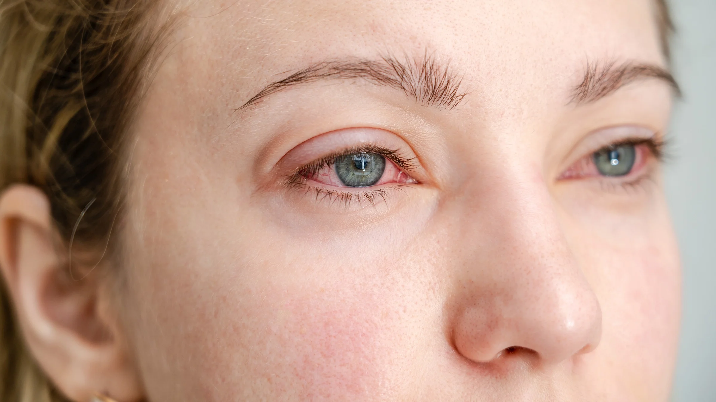 Close-up of a woman with red irritated eyes.