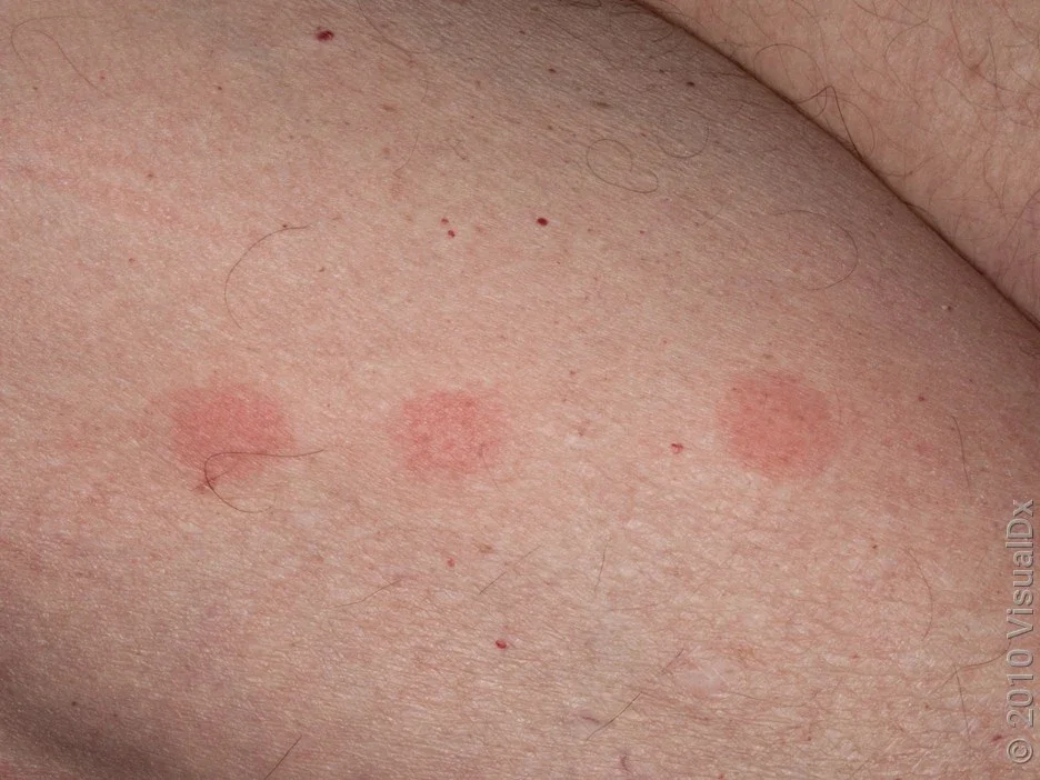 Close-up of leg with three red patches showing what bedbug bites look like.