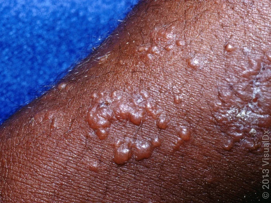 Close-up of a full-blown poison ivy, oak, or sumac rash with blisters. 