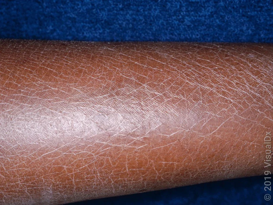 A close-up look of dryness and scaling on the leg. 