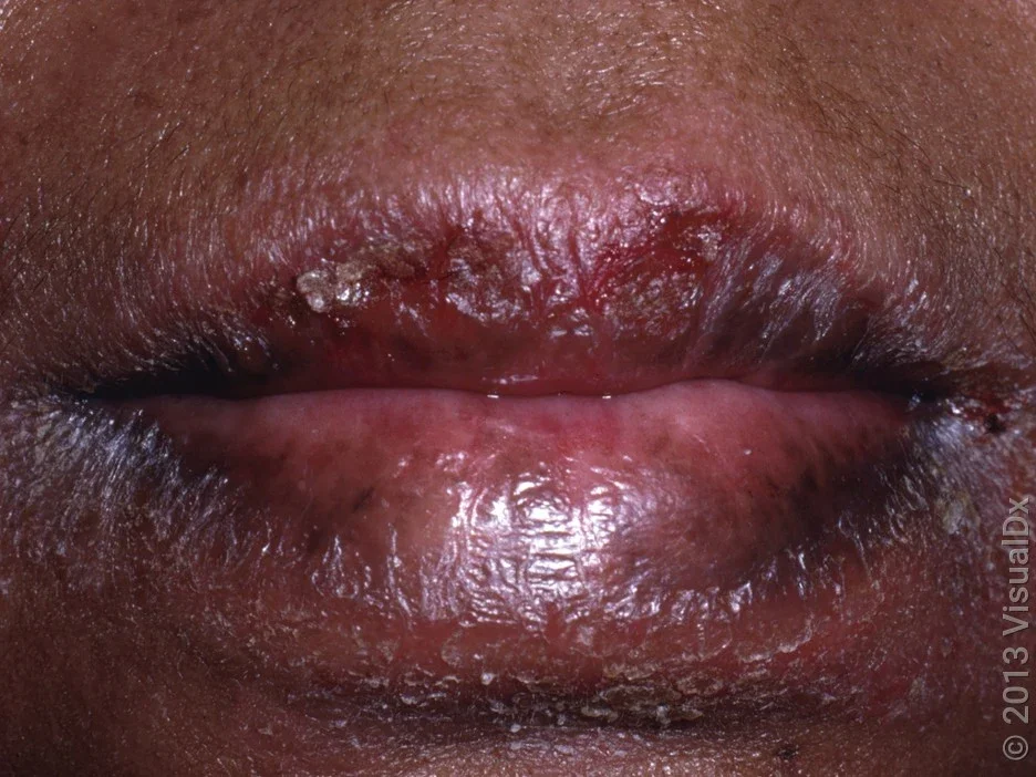 Close-up of dry, chapped lips (cheilitis) on darker skin. 