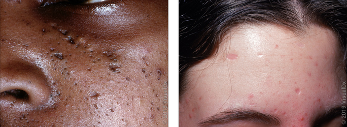 Left: Close-up of a cheek with acne scars. Right: Close-up of a forehead with acne scars and acne.