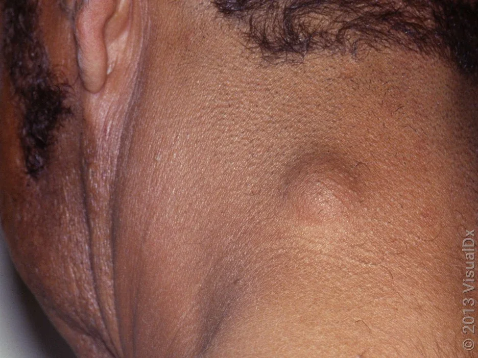 Close-up of a sebaceous cyst on the neck. 