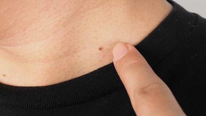Close-up on a small, brown skin tag on a person's neck.