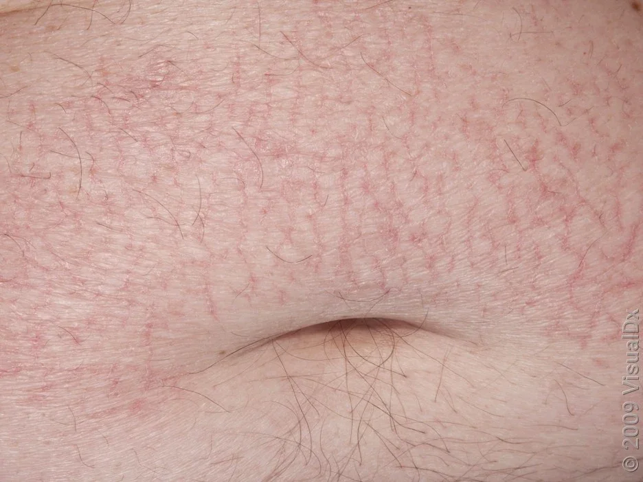 Asteatotic eczema on the abdomen. 
