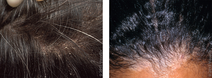 Left: Close-up of scalp hairs that have white flakes (dandruff). Right: Close-up of frontal hairline with mild flaking and lighter patches of skin (dandruff).