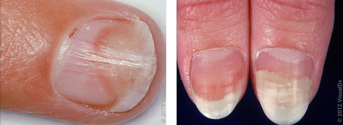 Left: Close up of fingernail with an orange-pink patch. Right: Close-up of fingernails with white, orange, and pink patches. 