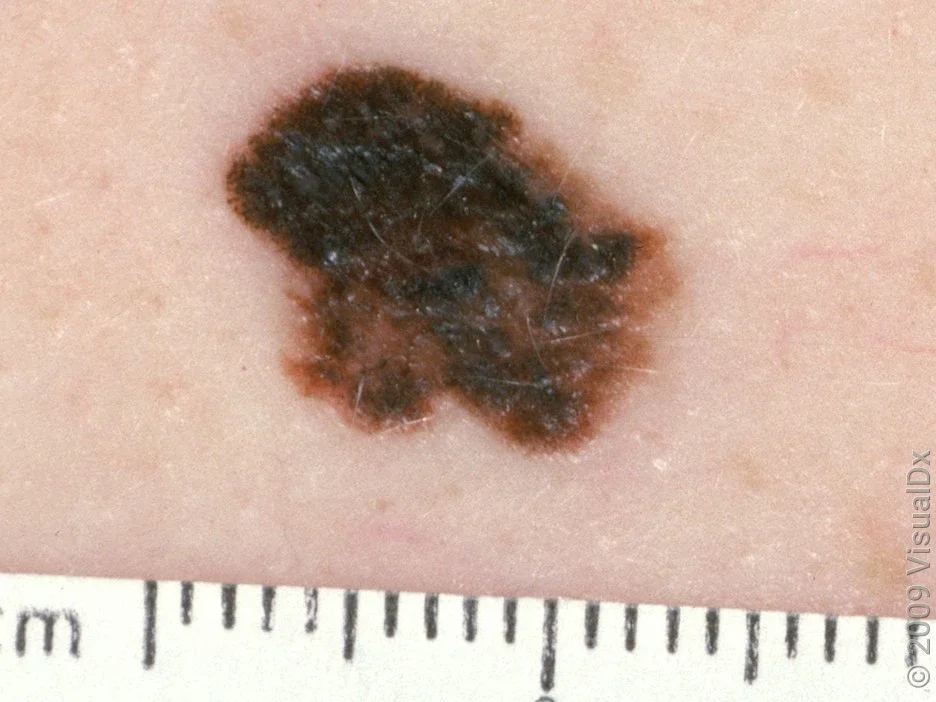 Close-up of a cancerous spot on the skin (melanoma).