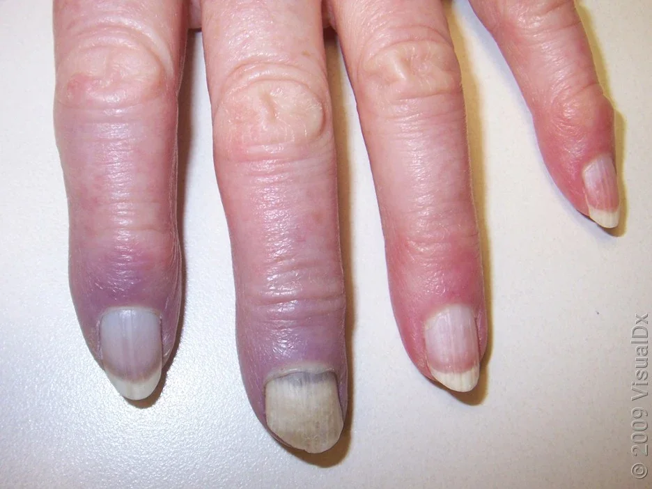 Close-up of Raynaud’s syndrome on the fingers. 