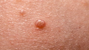 STDs: closeup molluscum ontagiosum on skin 1138549520
