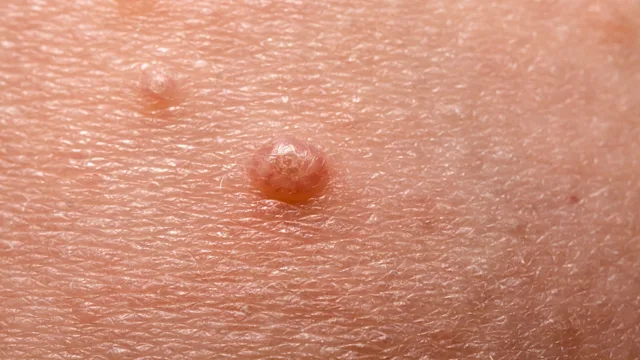 STDs: closeup molluscum ontagiosum on skin 1138549520