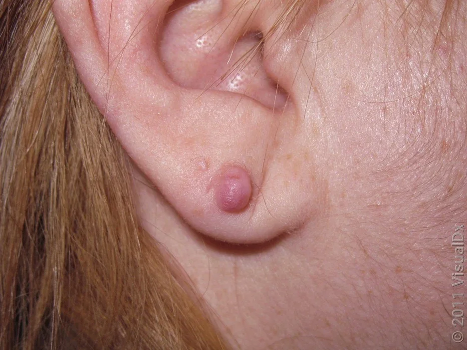 Close-up of a small keloid from an ear piercing. 
