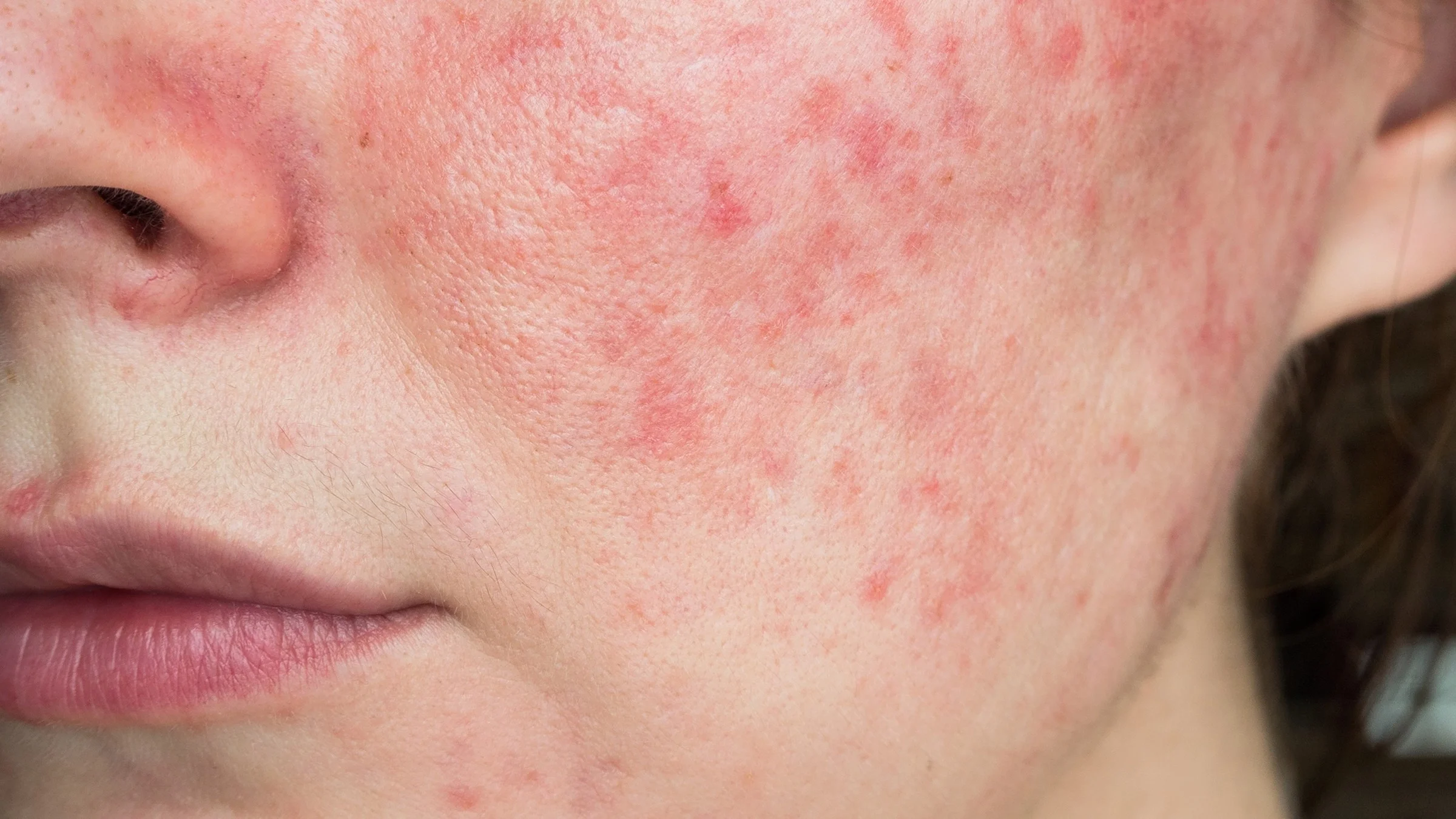 Extremely close-up of a woman's cheek with rosacea.