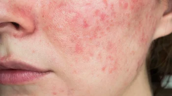 Health: Rosacea: GettyImages 1288087162
