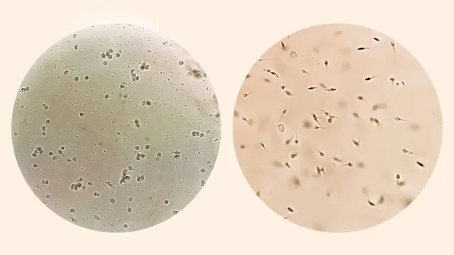 Fertility: Sperm after vasectomy: microscope view sperm before after-1338257226