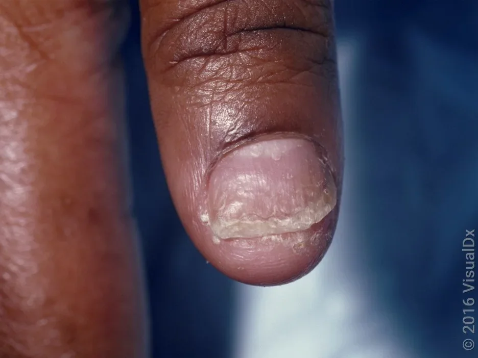 Close-up of a thickened and discolored fingernail in psoriasis.