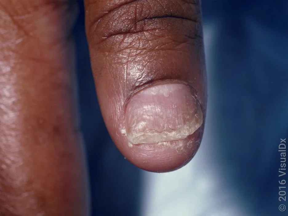 Close-up of a thickened and discolored fingernail in psoriasis. 