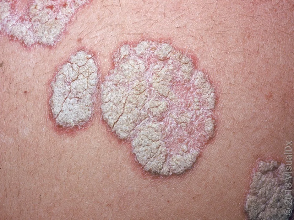 Close-up of plaque psoriasis. 