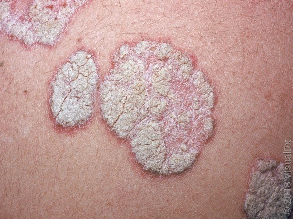 Close-up of plaque psoriasis. 