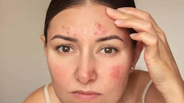Dermatology: woman with acne 2157945257