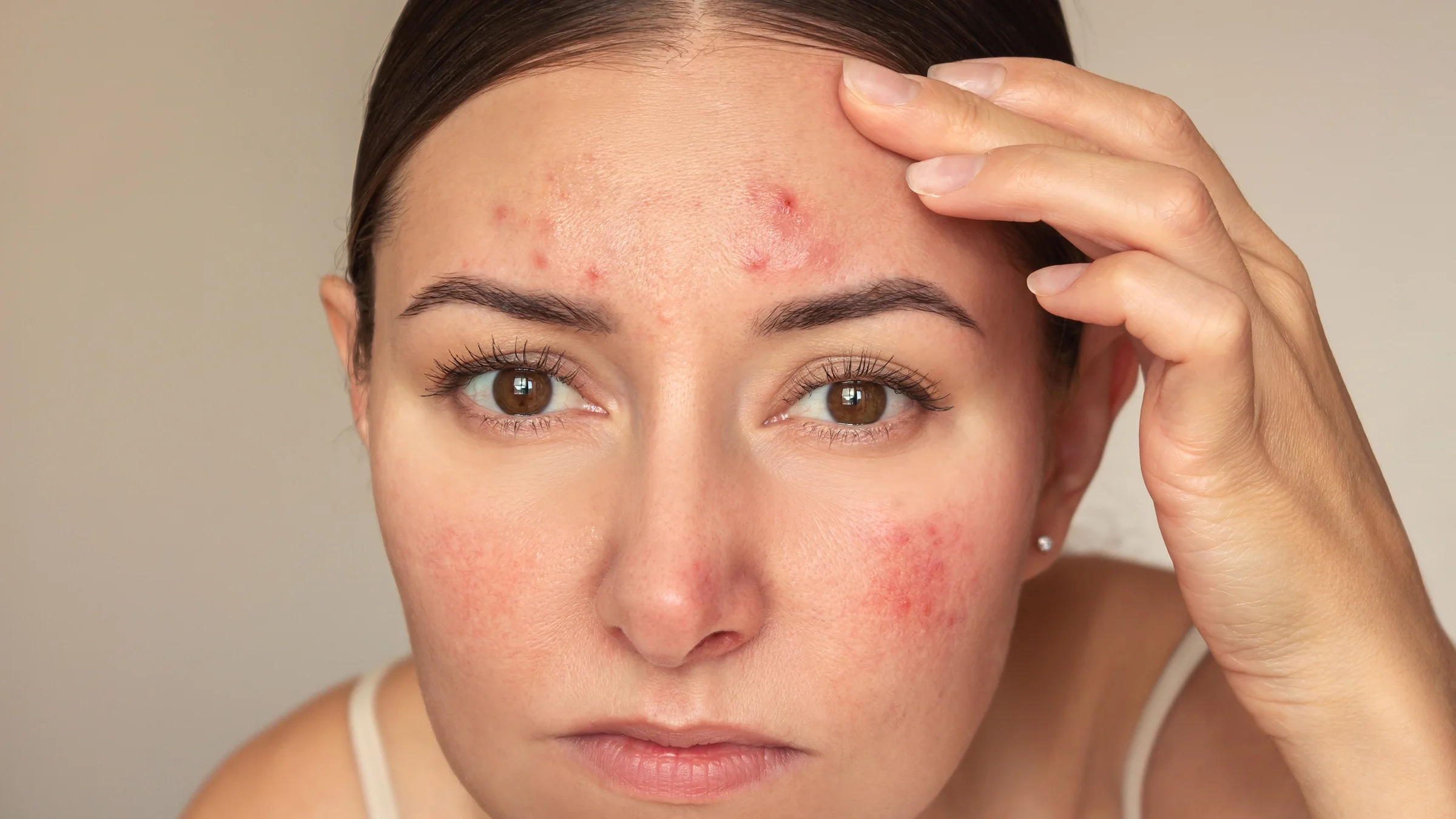 A woman looks at the acne on her face.