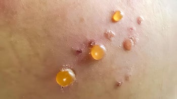 Dermatology: closeup bullous pemphgoid 2160530718