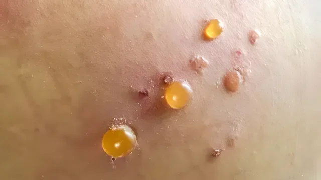 Dermatology: closeup bullous pemphgoid 2160530718