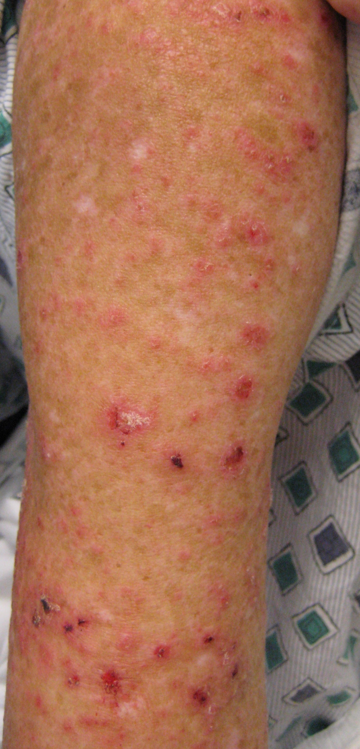 Lupus Rash What It Is And How To Treat It Goodrx 