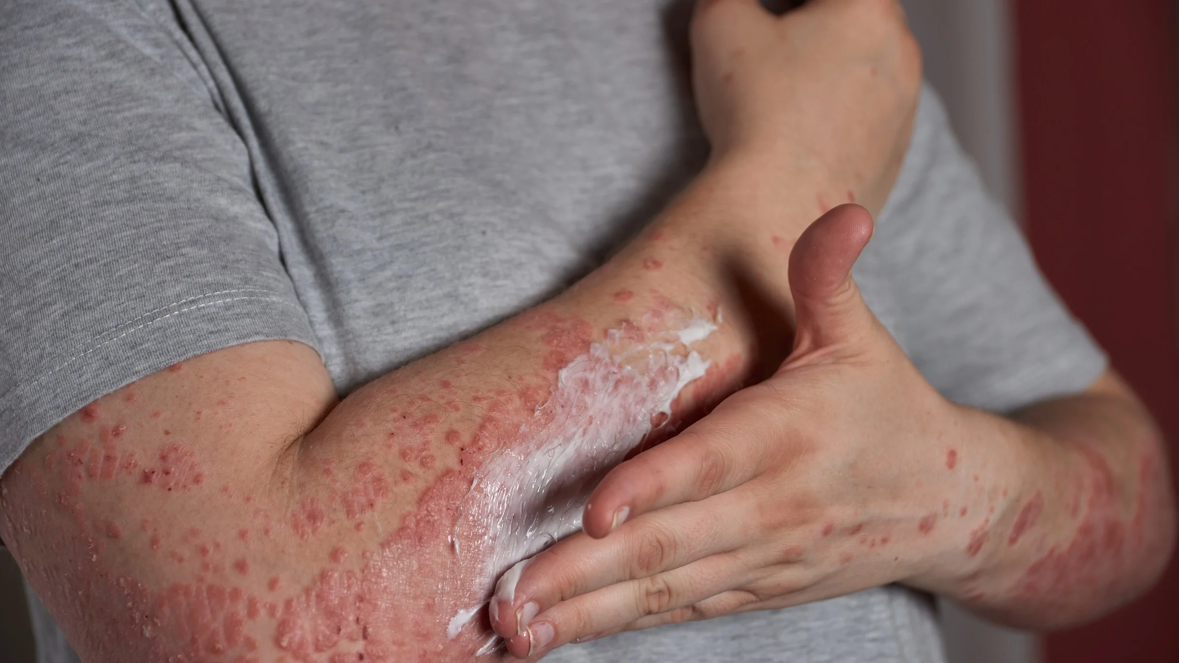 A cropped shot of someone with psoriasis applying cream to their arms.