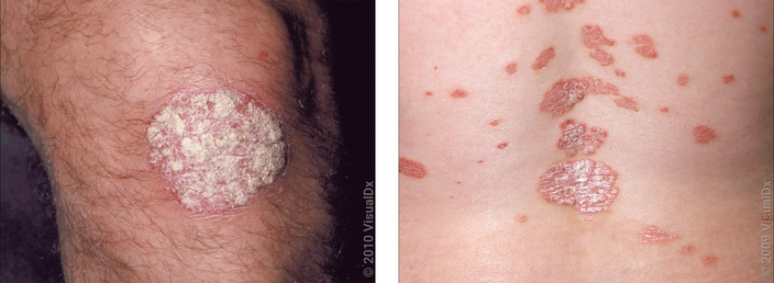 Left: Close-up of a knee with a thick, round, white patch in psoriasis. Right: Round and scaly red patches on the back in psoriasis.
