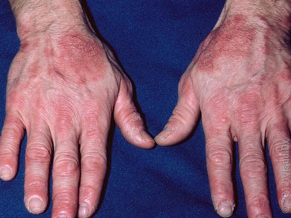 Close-up of hands with a rash caused by a latex allergy.