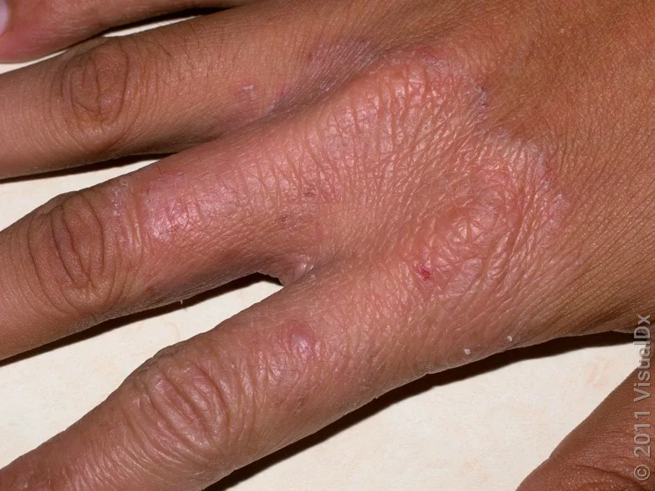 A fungus rash on the fingers and back of the hand.