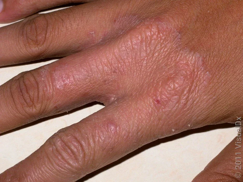 A fungus rash on the fingers and back of the hand.